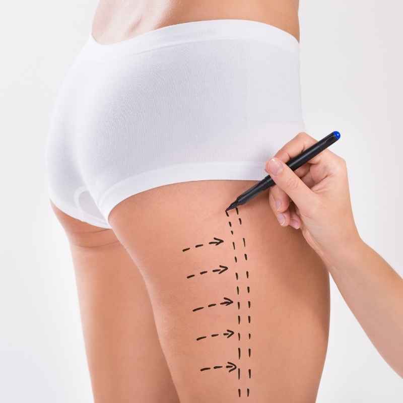 Liposuction Treatment in Nashik