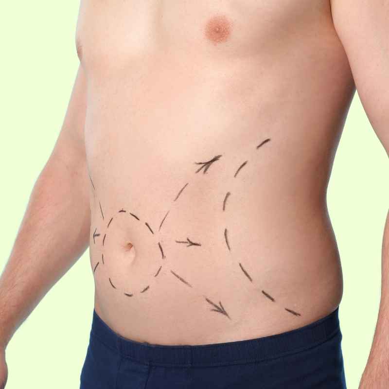 Male Abdominoplasty in Nashik by Dr. Neha Jain Aher