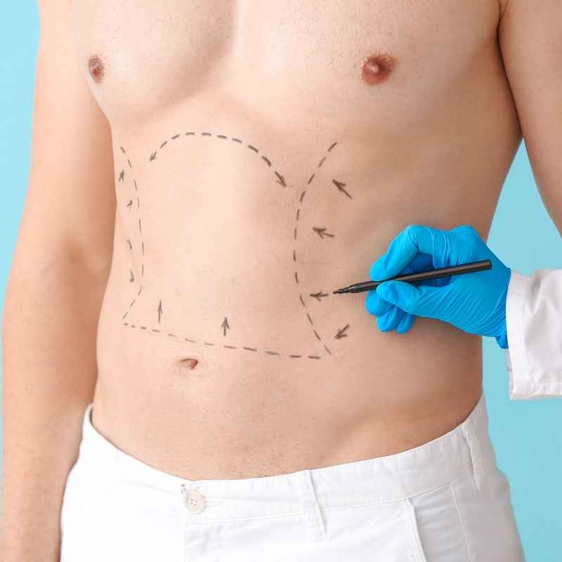 Male Liposuction in Nashik by Dr. Neha Jain Aher