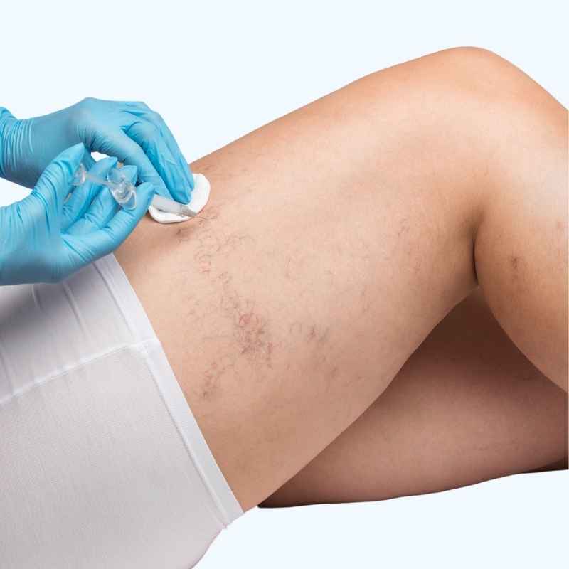 Spider Vein Treatment in Nashik by Dr. Neha Jain Aher