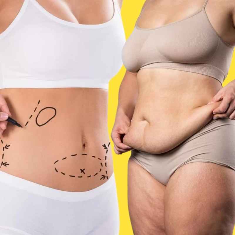 Abdominoplasty in Nashik by Dr. Neha Jain Aher